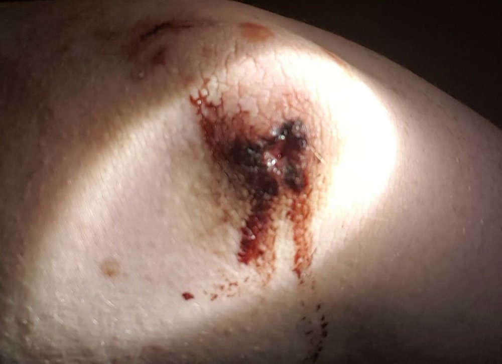 5aa4c2c8c4dcf_Elbowwound.thumb.jpg.edd251fcccd7064605e2d564b2051791.jpg